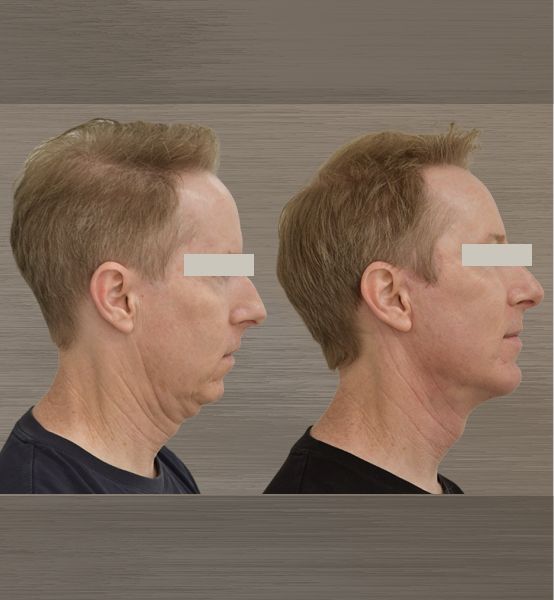 Before and after neck profile comparison.