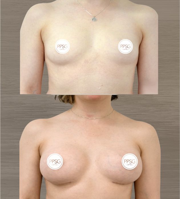Nude torso with circular stickers, front view.