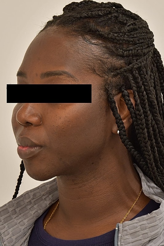 Facial Feminization Surgery Before & After