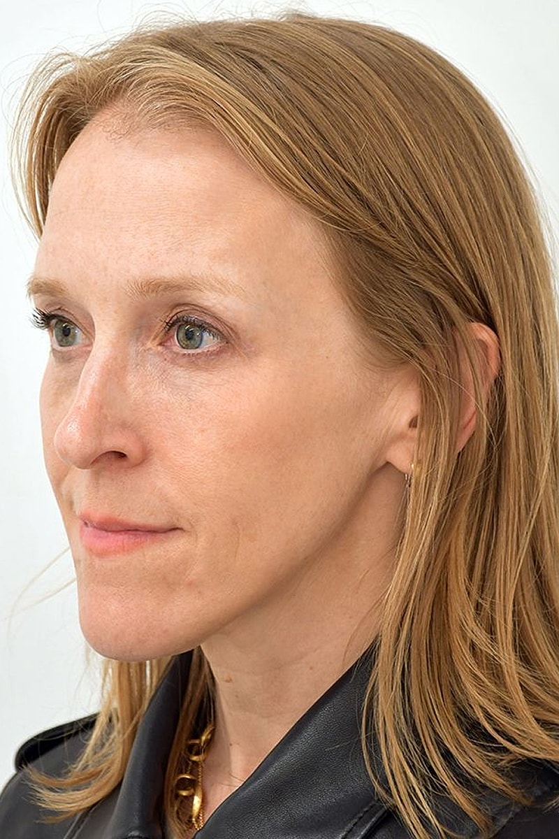 Brow Lift Before & After