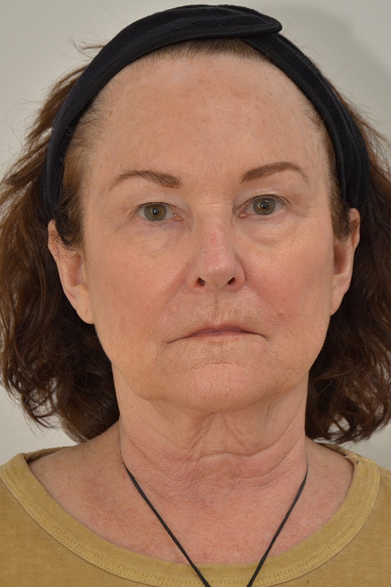 Brow Lift Before & After