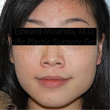 Jaw Reduction Before & After