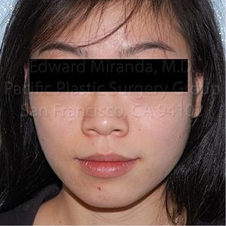 Jaw Reduction Before & After