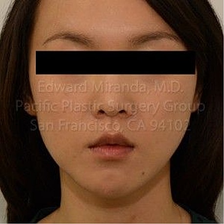 Jaw Reduction Before & After