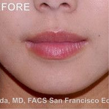 Jaw Reduction Before & After