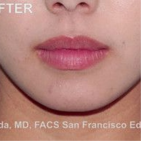 Jaw Reduction Before & After