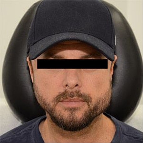 Jaw Reduction Before & After