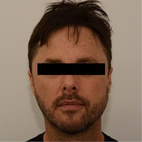 Jaw Reduction Before & After