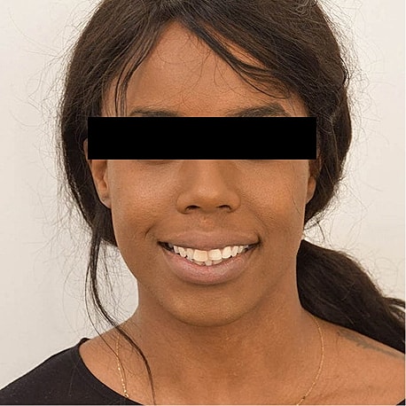 Jaw Reduction Before & After