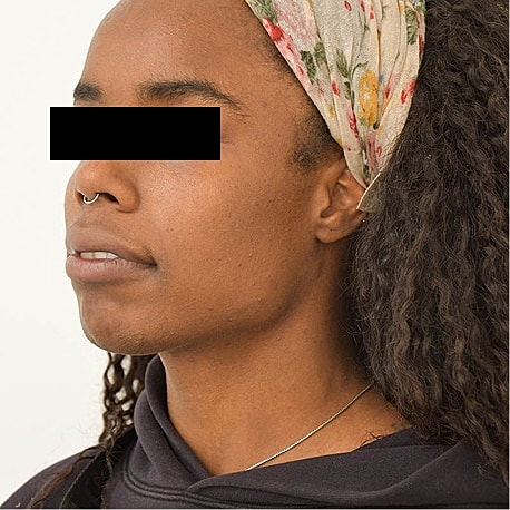 Jaw Reduction Before & After