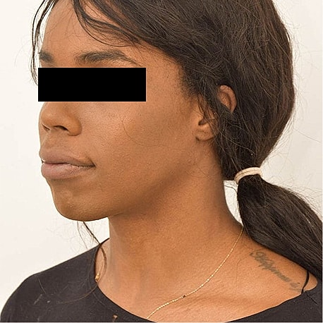 Jaw Reduction Before & After