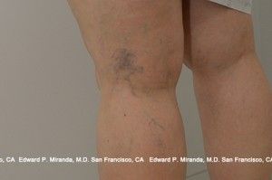Sclerotherapy Before & After