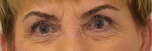 Blepharoplasty Before & After