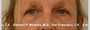 Blepharoplasty Before & After