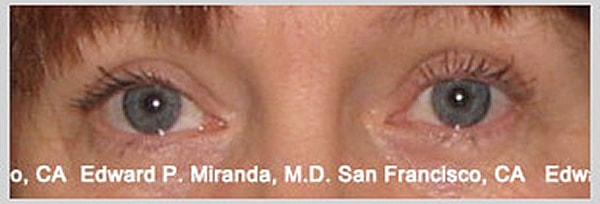 Blepharoplasty Before & After