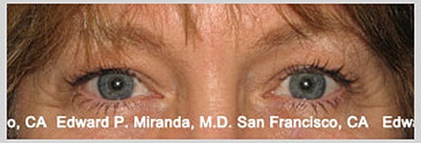 Blepharoplasty Before & After