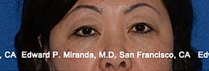 Blepharoplasty Before & After