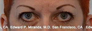 Blepharoplasty Before & After