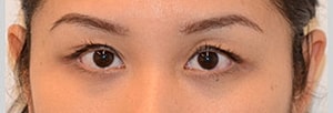 Blepharoplasty Before & After