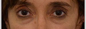Blepharoplasty Before & After
