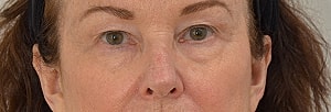 Blepharoplasty Before & After
