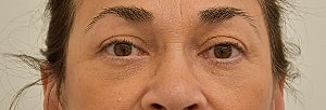Blepharoplasty Before & After
