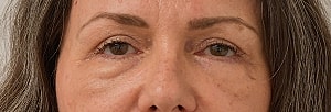 Blepharoplasty Before & After