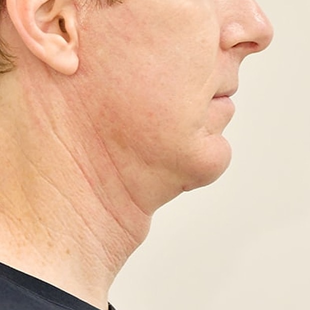 Chin Augmentation Before & After