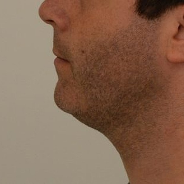 Chin Augmentation Before & After