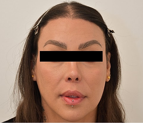 MTF Hair Gallery Before & After