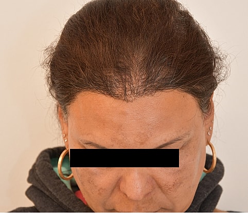 MTF Hair Gallery Before & After