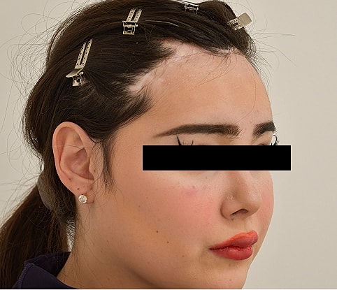 MTF Hair Gallery Before & After