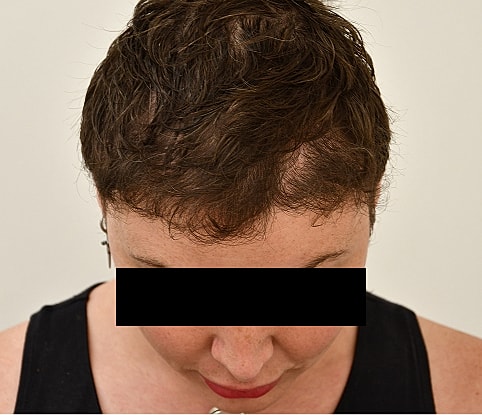 MTF Hair Gallery Before & After