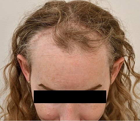 MTF Hair Gallery Before & After