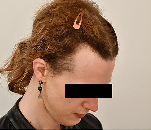 MTF Hair Gallery Before & After