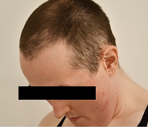 MTF Hair Gallery Before & After