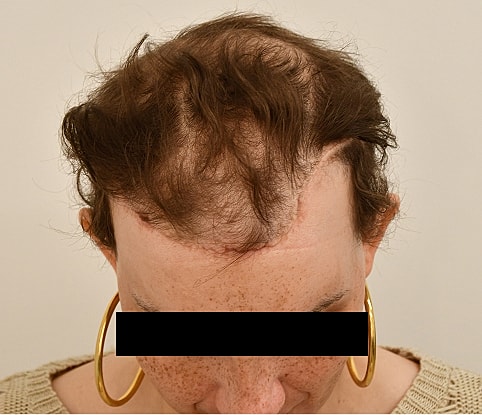 MTF Hair Gallery Before & After