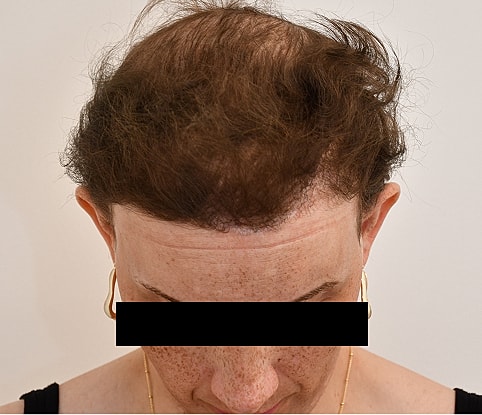 MTF Hair Gallery Before & After
