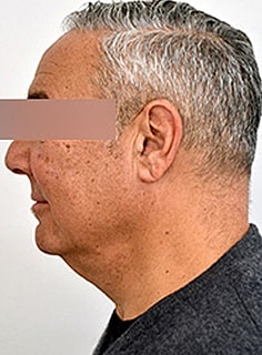 Facelift Before & After