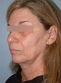Facelift Before & After