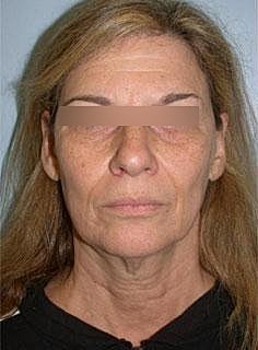 Facelift Before & After