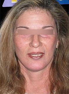 Facelift Before & After