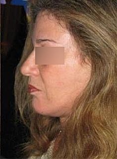 Facelift Before & After