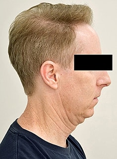 Facelift Before & After