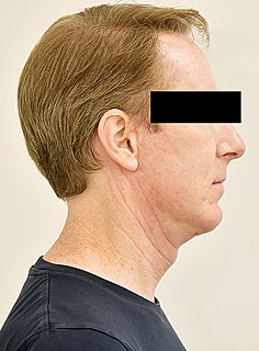 Facelift Before & After