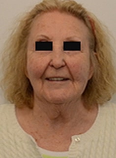 Facelift Before & After