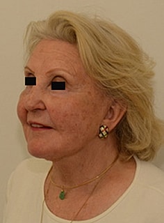 Facelift Before & After