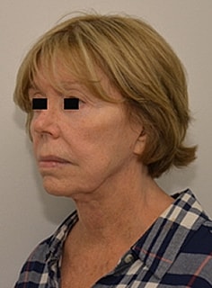 Facelift Before & After