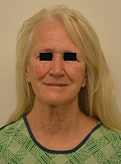 Facelift Before & After