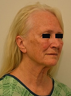 Facelift Before & After